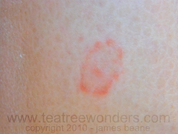 Ringworm: Picture, causes, symptoms and treatment