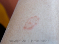 ringworm picture pictures of ringworm